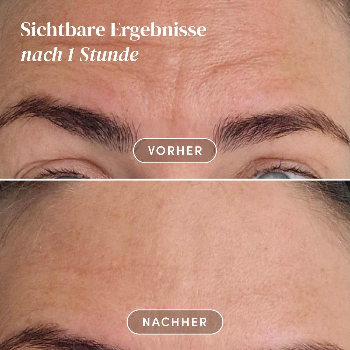 Wiederverwendbares Stirnpad Hyaluron «fantastic forehead»