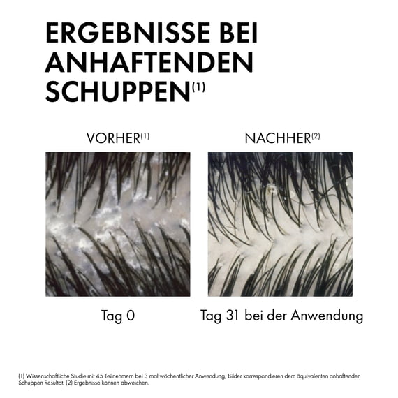 Anti-Schuppen Shampoo Trockene Kopfhaut
