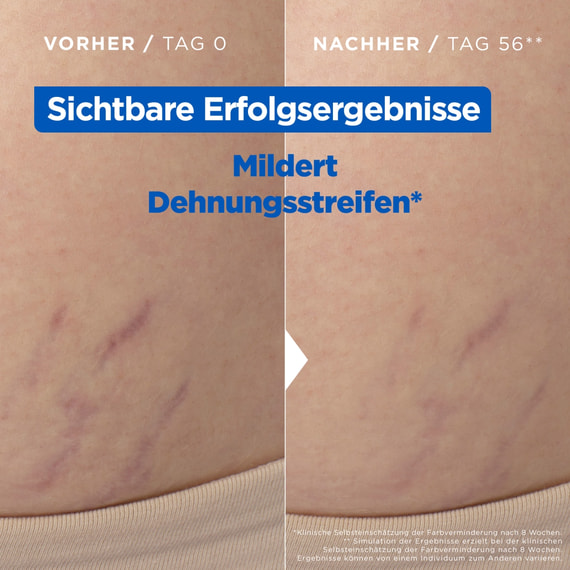 Stretchmark Oil