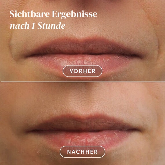 Mund Patches mit Hyaluron - Mini
