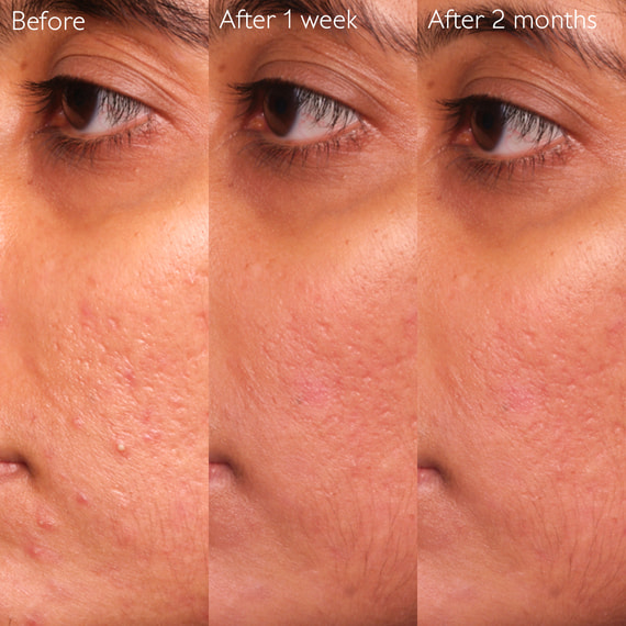 Blemish Control Serum
