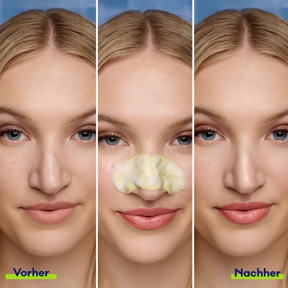 Porenverfeinernde Bubble Nasenmaske