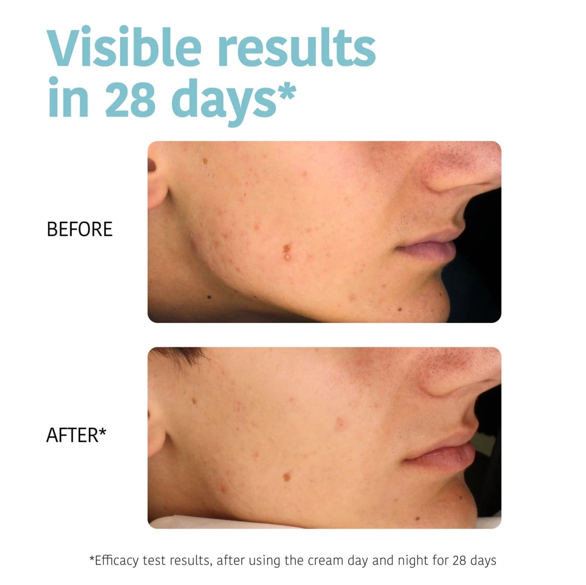 Oil Contol Anti-Blemish Face Cream with Salicylic Acid