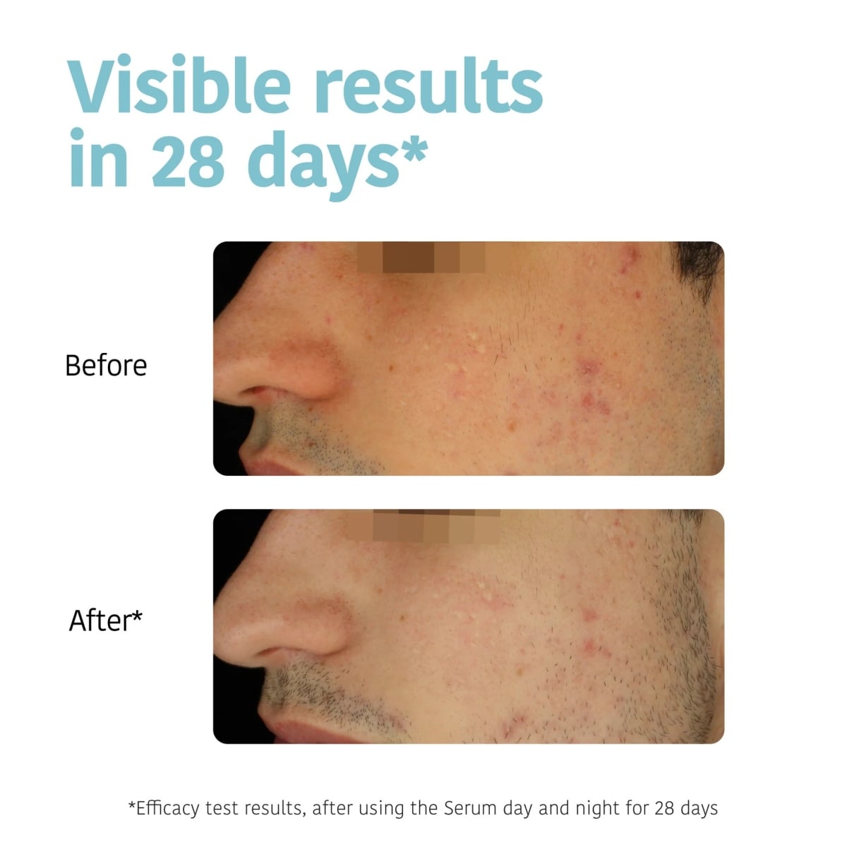 Prevent & Correct Anti-Blemish Face Serum with Salicylic Acid