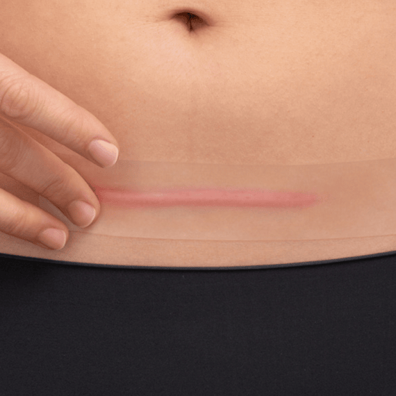 Scar Reduction XL