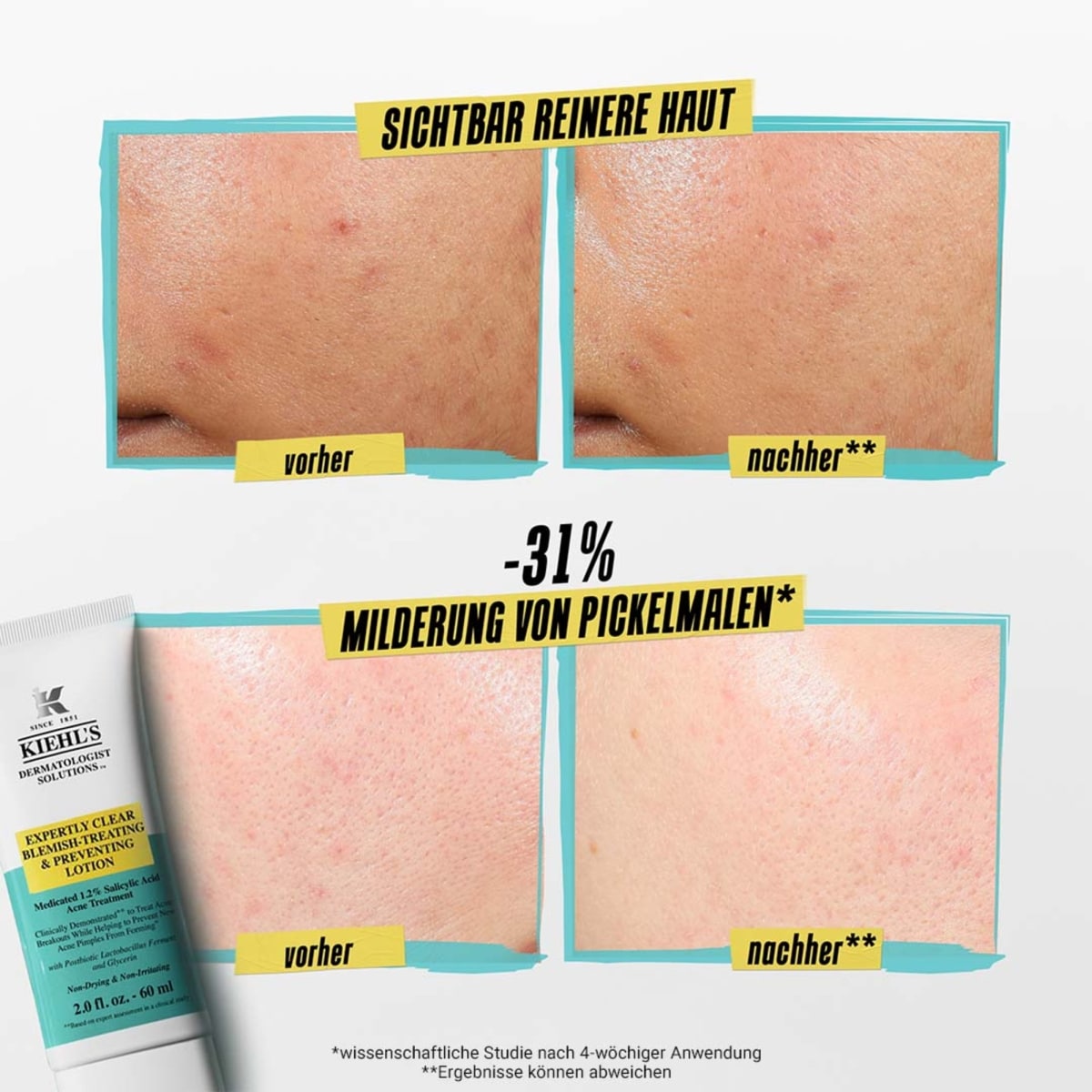 Expertly Clear Blemish Treating & Preventing Lotion