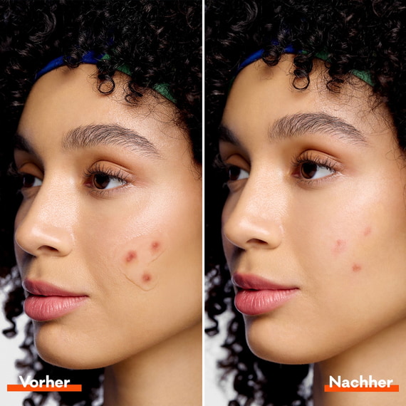 Anti-Pickel Unsichtbares Peel-Off Gel