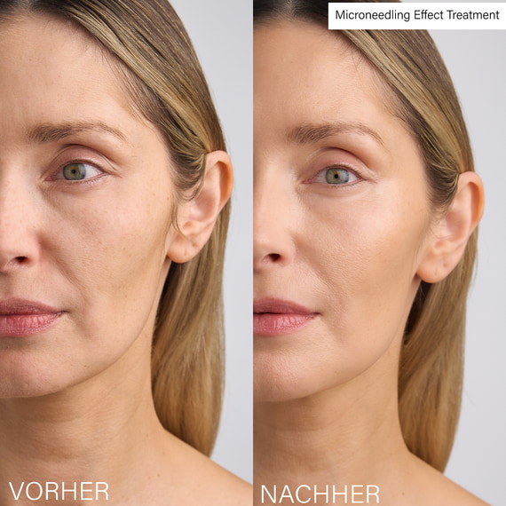 Mirconeedling Effect Treatment