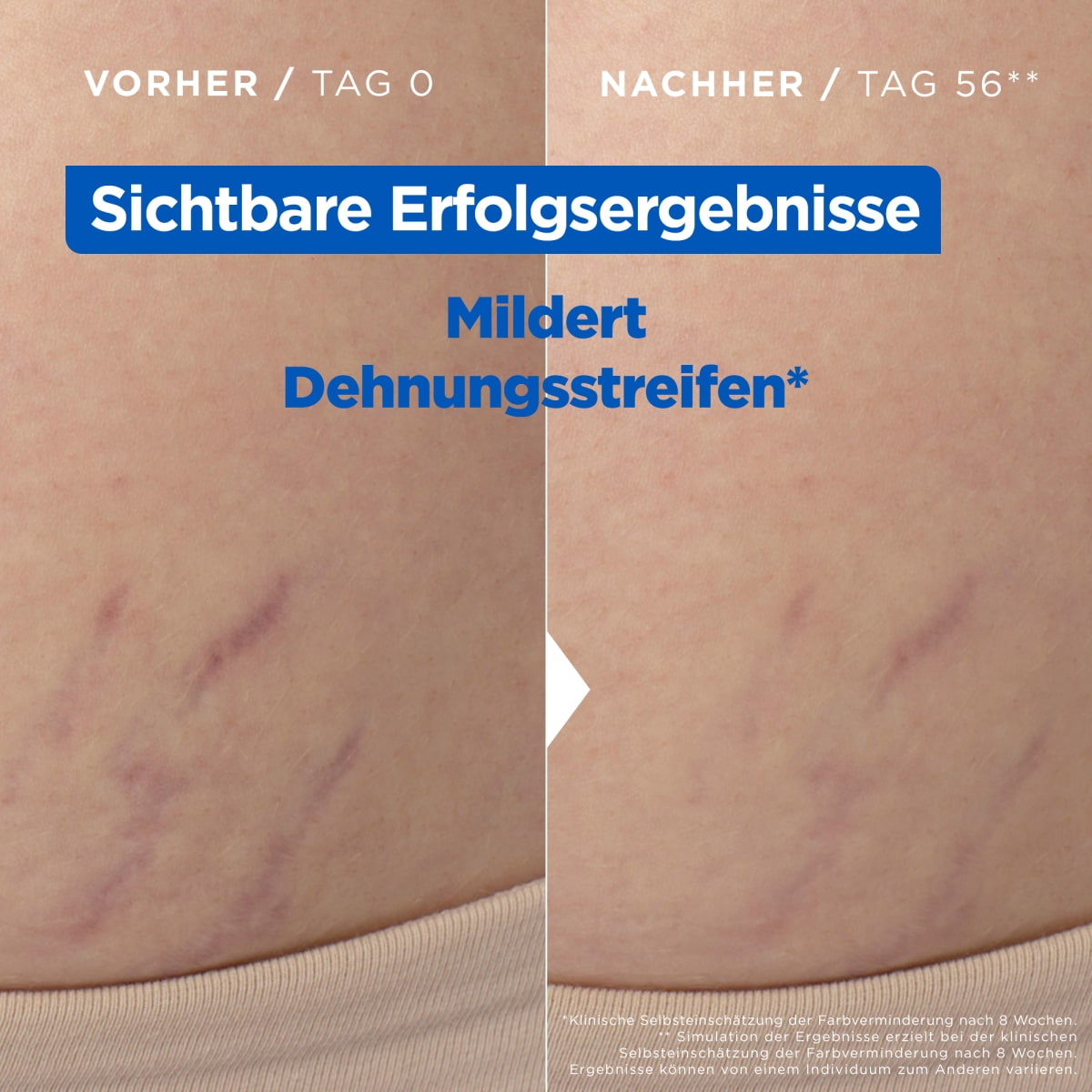 Stretchmark Oil