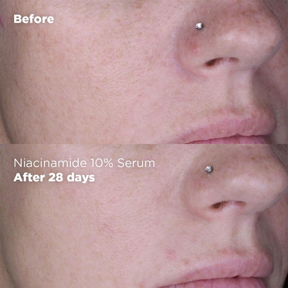 Sérum Niacinamide 10% + Zinc 1%