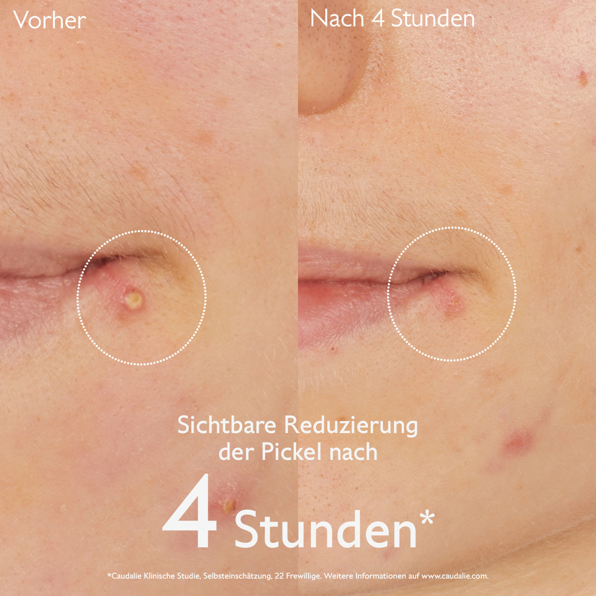 Pickel-Stopp