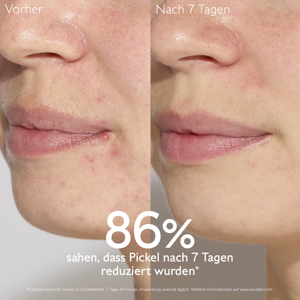 Serum gegen Unreinheiten