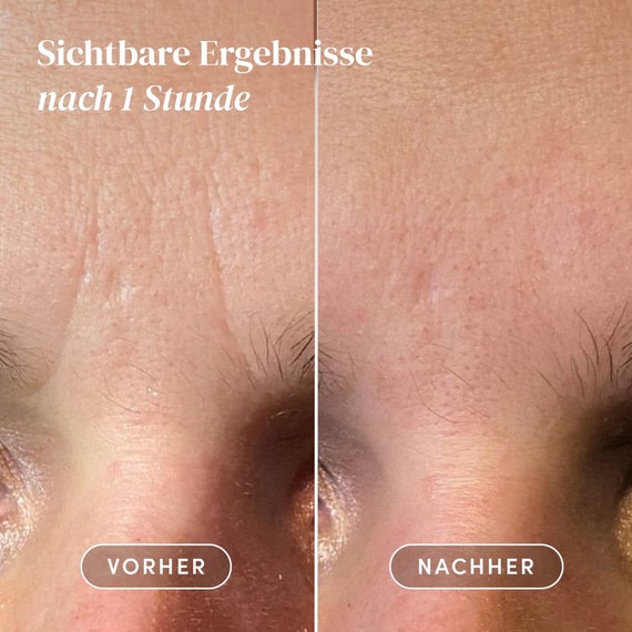 Gesicht Patches mit Hyaluron - Mini