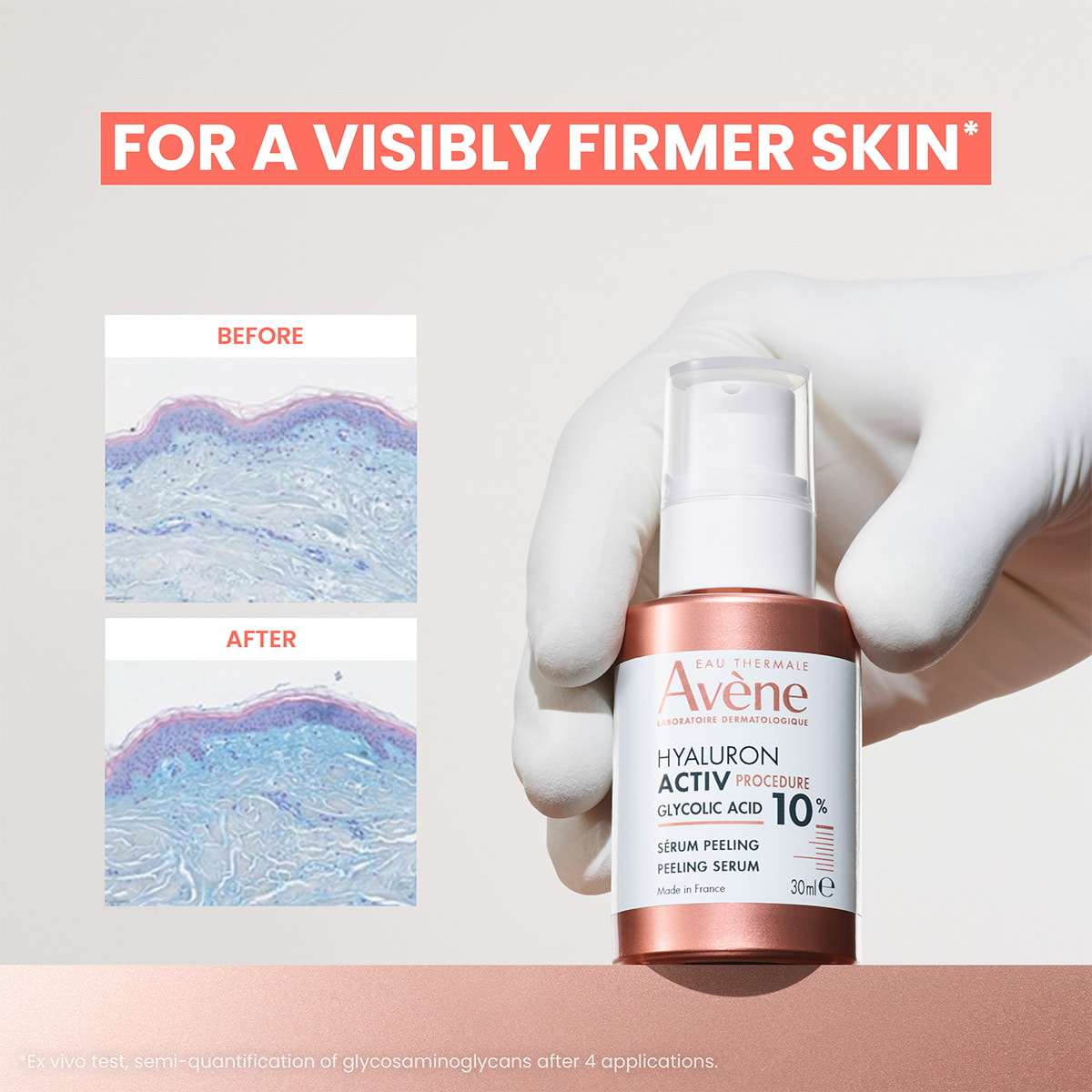 Siero Peeling