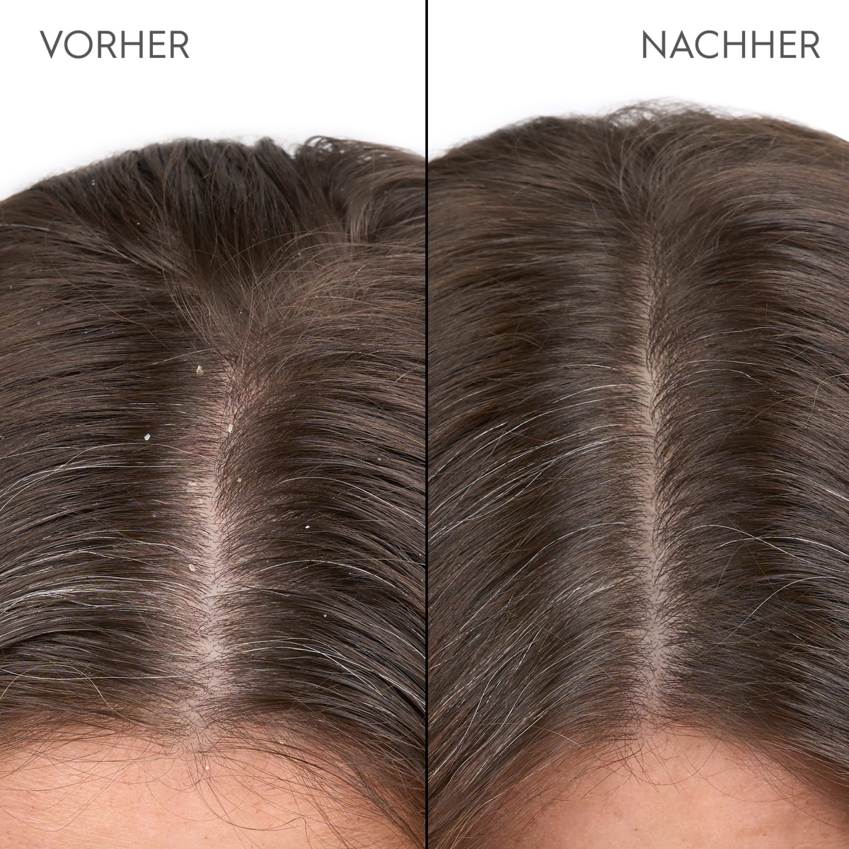 Anti-Schuppen Kopfhaut Serum